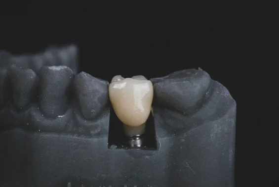 Dental Implants