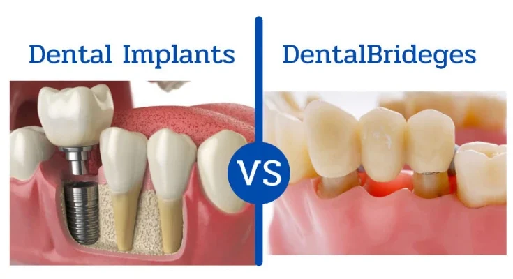 dental bridge vs implant