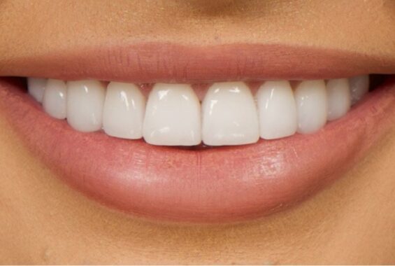 Veneers