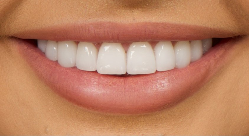 Veneers