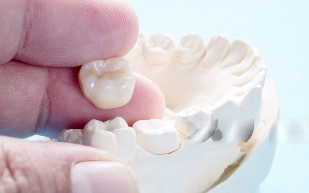 Dental Crowns