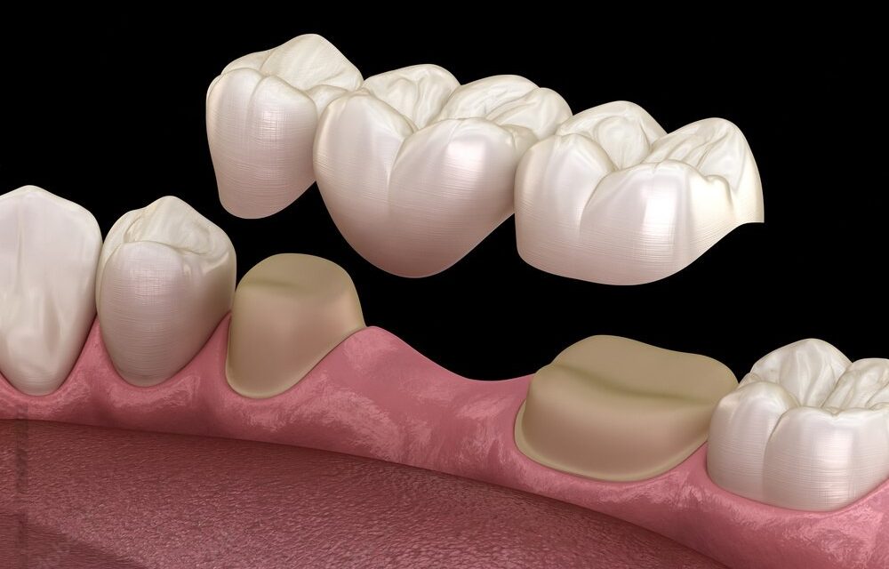 Dental Bridges