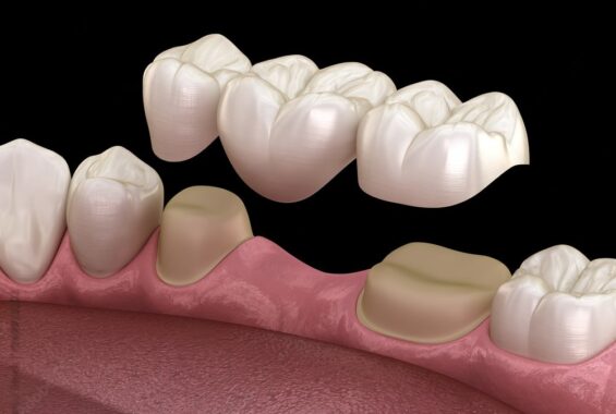 Dental Bridges