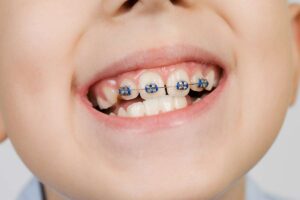 Benefits of Dental Braces for Children