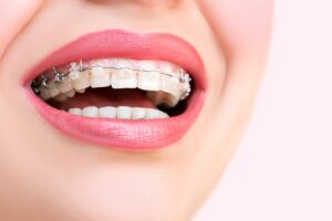 This image shows Benefits of Self-Ligating Braces