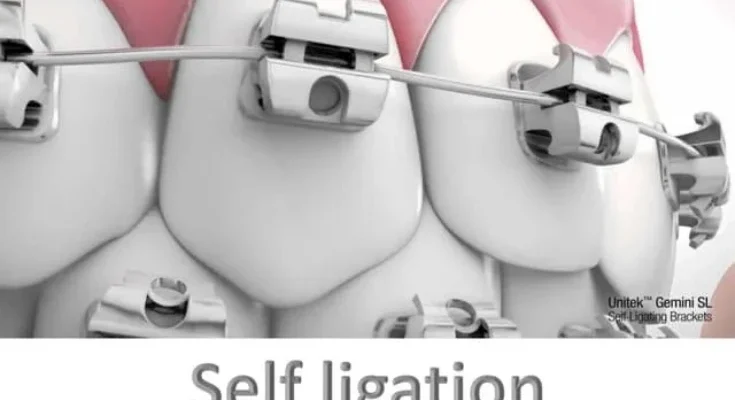 Cost of Self-Ligating Braces: Benefits, Cost, and Risk