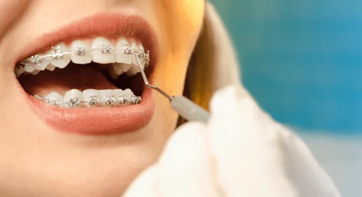 Dental Braces for Adults: Types, Cost, and Benefits