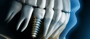 Finding the Best Implant Dentists