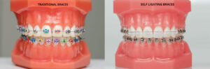 Self-Ligating Braces vs. Traditional Braces
