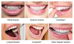 Types of dental braces
