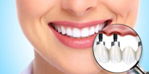 Why Consider Dental Implants