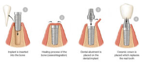dental Implant Surgery Process