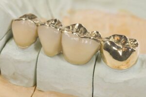 Are Silver Crown Tooth Safe?