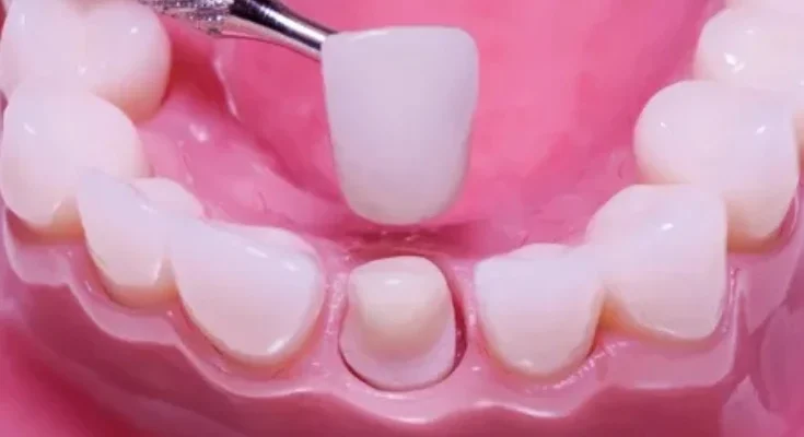 Front tooth crown