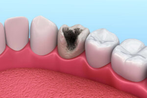 Symptoms of Small Cavity