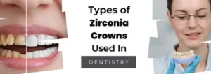 Types of Zirconia Crown