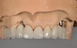 What are the advantages and disadvantages of Zirconia Crown