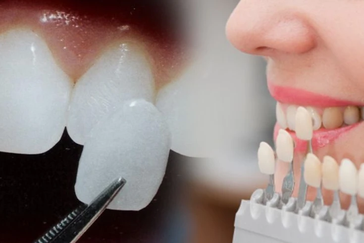 How Long Do Veneers Last?