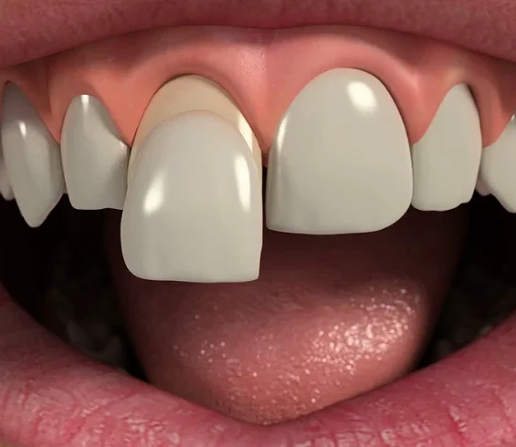 Porcelain Veneers: Procedure, Cost, and Risk