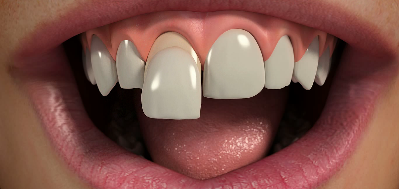 Porcelain Veneers: Procedure, Cost, and Risk