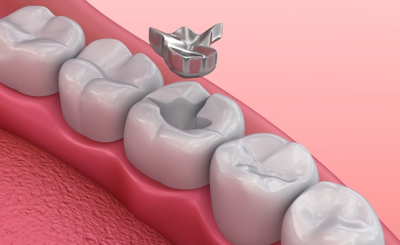 Teeth Filling Cost in Florida: types of fillings, with & without insurance